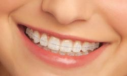 Clear sales braces elastics